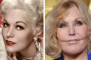 Những mỹ nhân Hollywood chịu di chứng nặng nề vì phẫu thuật thẩm mỹ