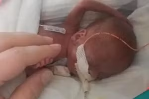 Em bé sinh non nặng hơn 300 gram đã sống sót một cách thần kỳ.
