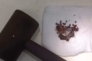 Nhét tiền xu vào mũi trong 53 năm, người đàn ông nhận cái kết ngỡ ngàng