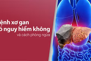 Tìm hiểu liệu rằng "Bệnh xơ gan có nguy hiểm không?"