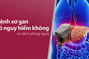 Tìm hiểu liệu rằng "Bệnh xơ gan có nguy hiểm không?"