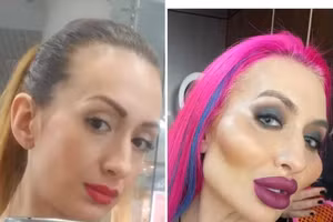 Người phụ nữ có đôi má lớn nhất thế giới vẫn muốn... phẫu thuật thẩm mỹ