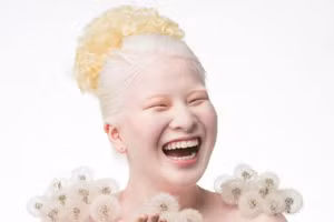 Từ đứa trẻ mắc bệnh bạch tạng bị bỏ rơi đến siêu mẫu Vogue nổi tiếng