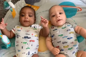 Kỳ lạ cặp song sinh một da đen, một da trắng 