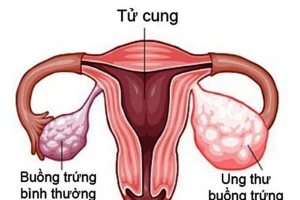 Ung thư buồng trứng xuất phát từ nhiều nguyên nhân, trong đó có nguyên nhân liên quan đến yếu tố di truyền.