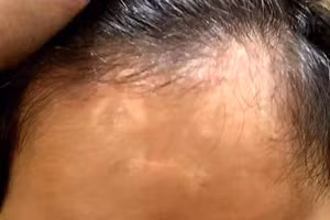 Phần đầu của cháu T. với những vết thương do "thầy" chữa bệnh tự kỷ Lê Minh Q. (bị tố vì làm chết một cháu bé khác khi chữa bệnh tự kỷ) gây ra (Ảnh: Gia đình cung cấp).