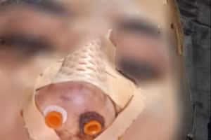 Mũi của chị T bị biến dạng sau khi phẫu thuật thẩm mỹ tại cơ sở thẩm mỹ viện Seoul Center tại TP Huế. (Ảnh: NVCC)