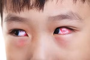 Dịch đau mắt đỏ ở Thừa Thiên - Huế đang tăng nhanh trong khối học sinh. (Ảnh: minh họa).