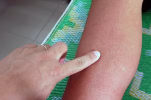 Bệnh nhân sốt xuất huyết phát ban đỏ.