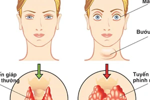 Bướu cổ là một khối u do tuyến giáp phình to tạo thành. Ảnh: IT