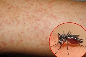 Khi tiểu cầu giảm sẽ dẫn tới xuất huyết như: Xuất huyết dưới da, niêm mạc (chảy máu cam, răng miệng, vị trí nơi tiêm truyền…). 