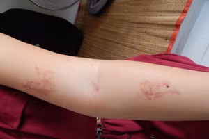 Vết thương do kiến ba khoang gây ra có thể để lại sẹo.