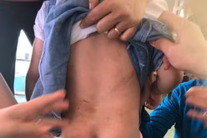 Các vết thương tích trên người cháu T.