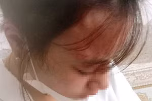 Nữ sinh L. được cơ quan chức năng giám định thương tật là 6%.