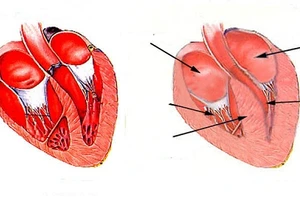 Tim bình thường (trái) và cơ tim bị giãn (phải).
