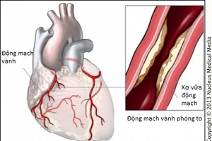 Cách phòng bệnh mạch vành