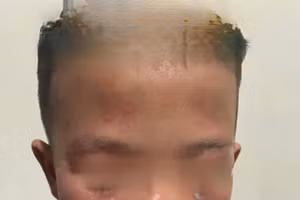 Học sinh bị dị ứng nặng sau khi tới lớp học.