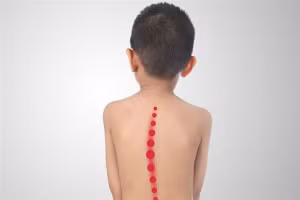 Thông thường, khi trẻ bị vẹo cột sống, hai bên bả vai sẽ có sự chênh lệch cao thấp.