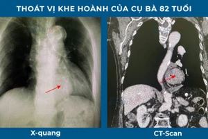 Thoát vị khe hành ở bệnh nhân 82 tuổi. Ảnh: BVCC.