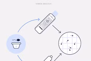 Để biết khả năng sinh sản của người bệnh, cần lấy mẫu tinh dịch của nam giới sau khi xuất, sau đó, phân tích dưới kính hiển vi.