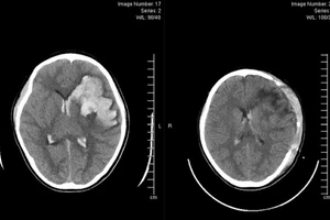 Bệnh nhi xuất huyết não do vỡ khối thông động tĩnh mạch não (AVM). Ảnh: BVCC.