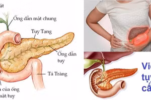 Biểu hiện của bệnh viêm tụy cấp.