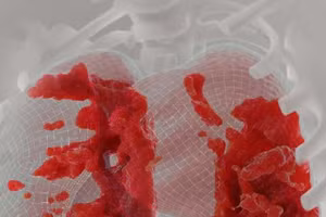 Công cụ mới có thể tiết lộ các dấu hiệu xơ hóa phổi ở những người mắc bệnh Covid-19.