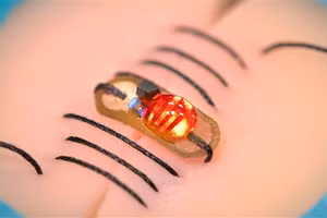 Chỉ khâu thông minh sẽ phát tín hiệu nếu phát hiện biến chứng.