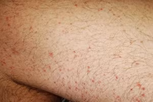 Người mắc Covid-19 có thể phát ban trong giai đoạn hồi phục. 