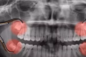 Tại sao răng khôn mọc muộn?