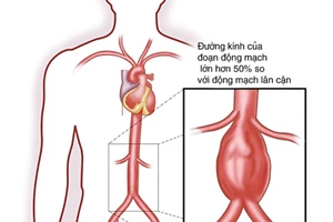 Bệnh hay gặp ở người cao tuổi, tăng huyết áp, xơ vữa mạch máu. Ảnh minh họa.