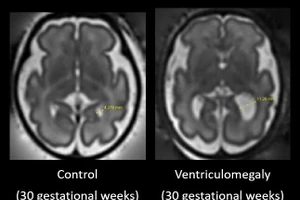 Các nhà nghiên cứu đã sử dụng hình ảnh chụp cộng hưởng từ não của trẻ em bị chứng giãn não thất thai nhi.