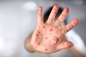 Với tay chân miệng, nếu tình trạng bệnh nhẹ, sau 7 - 10 ngày chăm sóc tại nhà, trẻ sẽ hồi phục hoàn toàn. Ảnh minh họa.