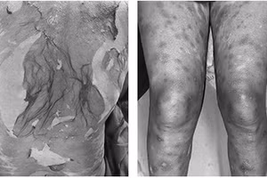 Theo thời gian, các thương tổn xuất hiện thêm ở lòng bàn chân hai bên, thân mình, tay, chân, hoại tử da lan rộng.