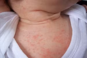 Cha mẹ cần duy trì lau mồ hôi thường xuyên, mặc quần áo thoáng mát cho trẻ. Ảnh minh họa