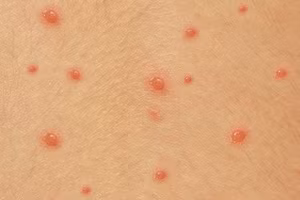 Người bị bệnh thủy đậu có thể mọc khoảng 100 - 500 nốt. Ảnh minh họa.