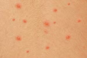 Thủy đậu là bệnh nhiễm trùng do virus varicella-zoster gây ra. Ảnh minh họa