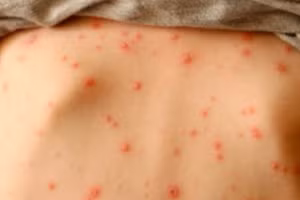 Từ đầu năm đến nay, Hà Nội ghi nhận 985 ca mắc thủy đậu. Ảnh minh họa.