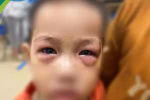 Trẻ bị đau mắt đỏ khám tại Bệnh viện Nhi Trung ương. Ảnh: BVCC