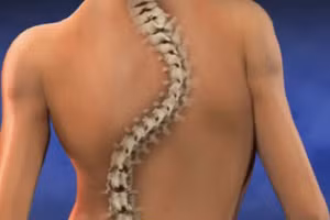 Hoạt động sai tư thế gây vẹo cột sống là vấn đề phổ biến. Ảnh minh họa