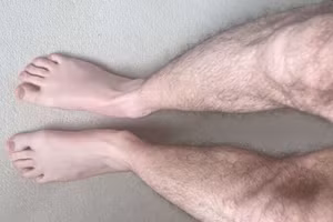 Chân bệnh nhân bình thường trở lại sau khi ngồi. 