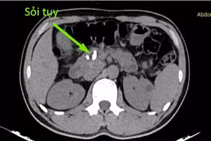 Sỏi tụy ở bệnh nhân. (Ảnh: BVCC)
