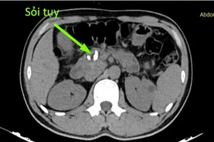 Sỏi tụy ở bệnh nhân. (Ảnh: BVCC)