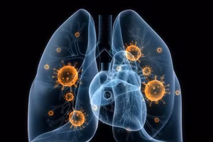 Ung thư phổi nếu được phát hiện sớm có thể được chữa khỏi.