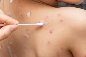 Hiện đã có thuốc điều trị đặc hiệu chống virus thủy đậu là Acyclorvir. (Ảnh minh họa)