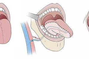 Nhiệt miệng mãi không khỏi, đi khám phải cắt 1/2 lưỡi: cách phân biệt ung thư và nhiệt miệng