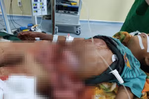 Bệnh nhân bị toạc ngang thành bụng vừa được Bệnh viện Đa khoa tỉnh Kon Tum cứu sống.