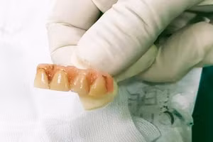 4 chiếc răng giả bệnh nhân nuốt vào hành tá tràng được lấy ra thành công.