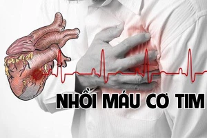 Những dấu hiệu nhận biết bệnh nhồi máu cơ tim, ai cũng nên thận trọng