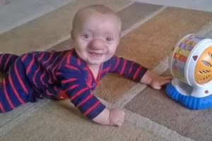 Cuộc sống đầy nghị lực của cậu bé "Pinocchio đời thật" với chiếc mũi dị dạng 